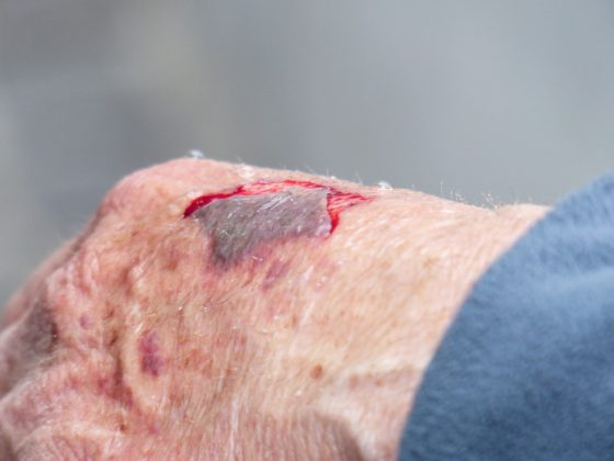 Premiata Rete lesioni cutanee di Asl Toscana sud est