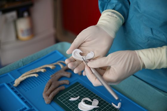 Al Meyer ricostruito l’orecchio a un bambino grazie alla stampa 3D